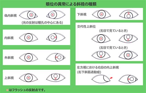 眼睛脫窗面相|斜視